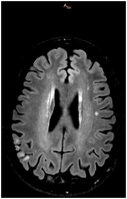 Case report: 10 years follow-up of psychosis due to Fahr’s disease complicated by a left temporal stroke